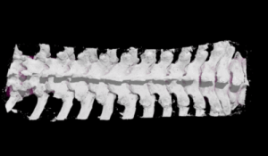 London Startup Raises the Bar on spinal implants